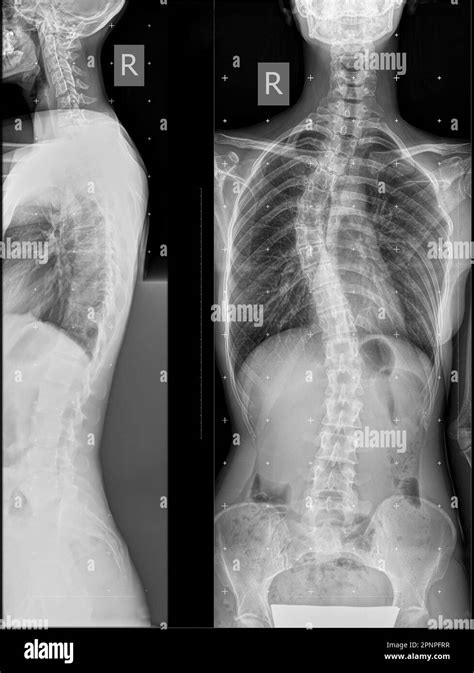 Radiographie Panoramique Du Rachis En Deux Projections D Formation Du