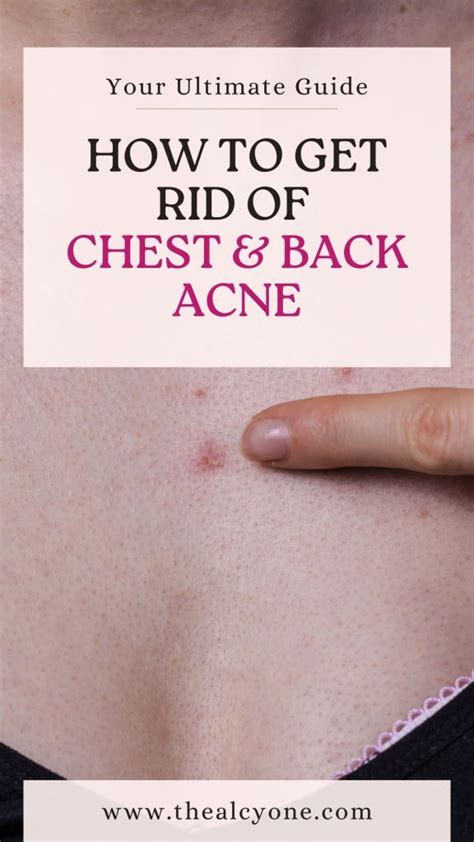 How To Get Rid Of Chest Acne And Bacne The Alcyone Chest Acne