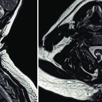 Postoperative Sagittal Left And Axial Right T2 MRI Of The Cervical