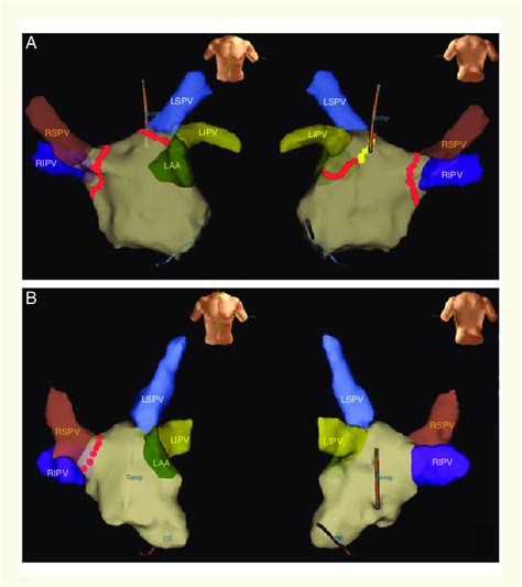 Left Atrial Electro Anatomical Maps From The Index And The Re Do