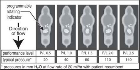 Programmable Csf Shunt Valves Radiographic Identification Off