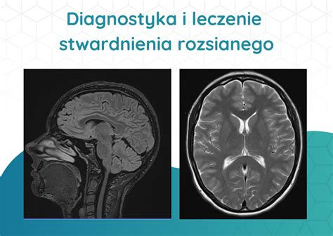 Rola Rezonansu Magnetycznego W Diagnostyce I Leczeniu Stwardnienia