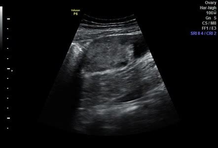 Ovarian Torsion Radiology Case Radiopaedia Org