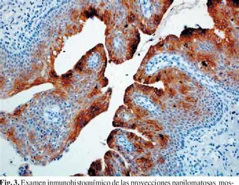 Figure 3 From Denture Hyperplasia With Areas Simulating Oral Inverted