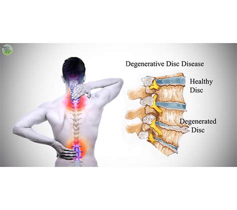 Degenerative Disc Victory Spine Center In Vacaville Ca