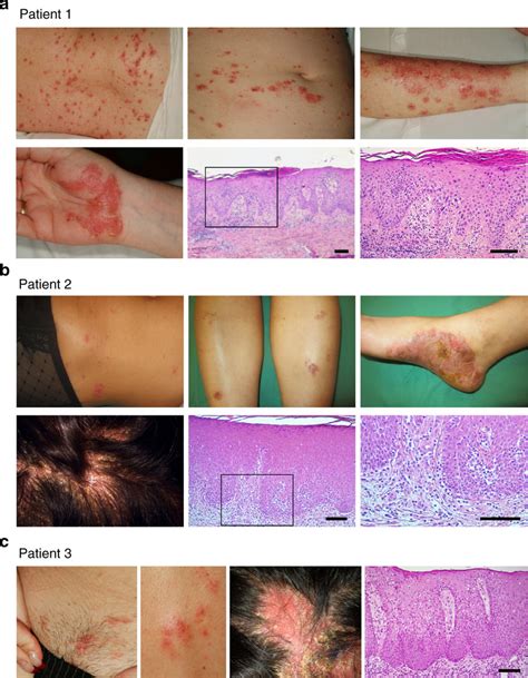 Clinical And Histological Presentation Of Paradoxical Psoriasis A C Download Scientific