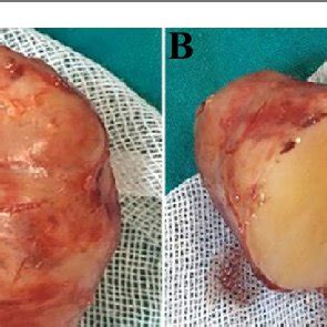 Gross Appearance Of The Surgically Excised Wellcircumscribed