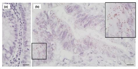 Adam Fhl Pla In A Normal Colonic Mucosa And B Colorectal