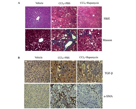 Rapamycin Ameliorates Ccl4 Induced Liver Fibrosis In Mice Through