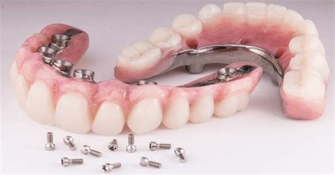 Full Mouth Dental Implants In Ponte Vedra [Rated 5-Stars]