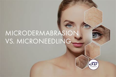 Microdermabrasion Vs Microneedling Skinbase™ Pro