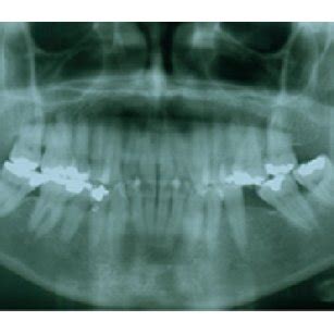 Clinical view of the sialolith after surgical removal. | Download ...