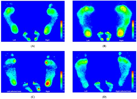 Jpm Free Full Text Traceable Features Of Static Plantar Pressure