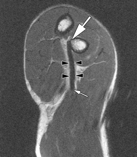 Distal Bicep Tendon Mri