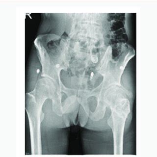 Plain Radiograph Of Pelvis With Bilateral Hipsanteroposterior View