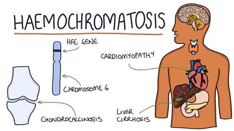 Studying Medicine On Twitter Hemochromatosis Autosomal Recessive