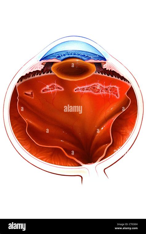 Mature Cataract High Resolution Stock Photography and Images - Alamy