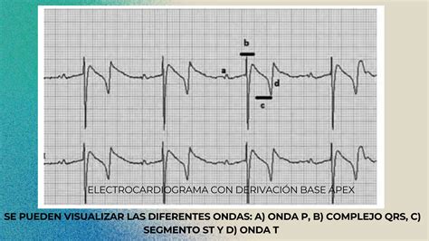 Estudio De Caso Cl Nico Electrocardiograma Pptx Descarga Gratuita