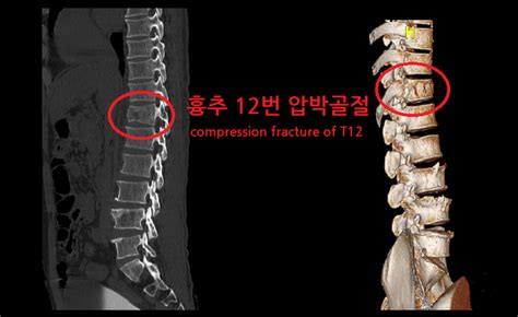 척추압박골절 흉추압박골절 후유장해 보상 흉추 12번 네이버 블로그