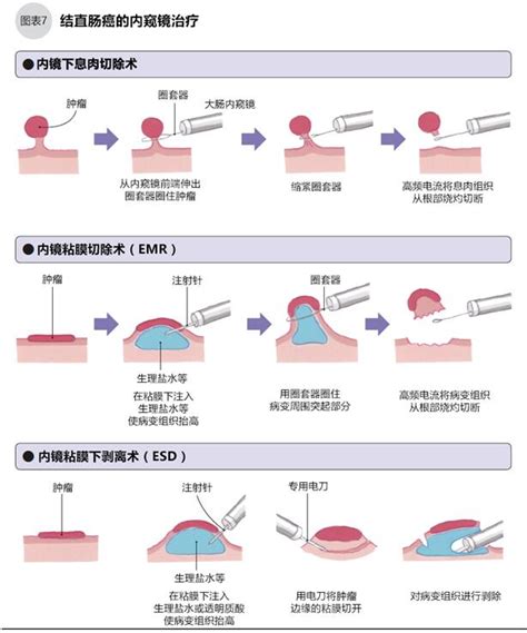 结直肠癌 日本就医网