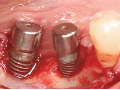 Peri Implantitis Definition Treatment And Implant Material