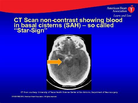 Aneurysmal Subarachnoid Hemorrhage Edited Version Of Aha Presentation