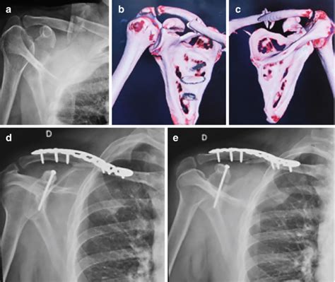 Special Considerations Fractures Of The Coracoid Process And Acromion Springerlink