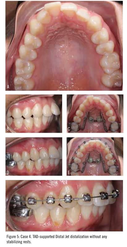 Maxillary Distalization With TADs Orthodontic Products