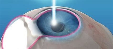 Cirugias Refractivas LASIK PRK SMILE Dr Reichmann