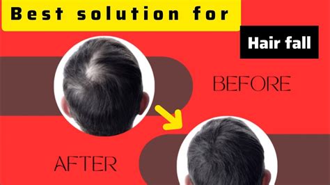 Best Solution For Hair Fall Best Solution For Hair Loss The Best Hair Loss Treatment Hair