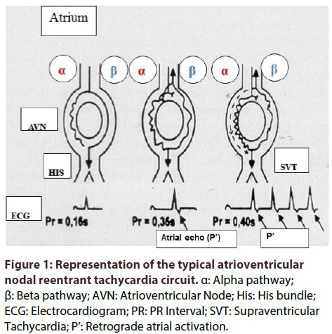 Typical Atrioventricular Nodal Reentrant And Orthodromic Atrioven