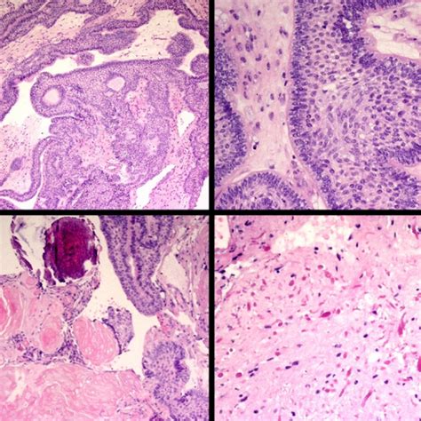 Radiopaedia Case Adamantinomatous Craniopharyngioma Id Study