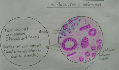 Histopathology Drawings: Pleomorphic adenoma