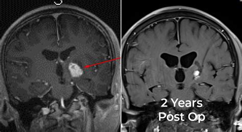 Thalamic-tumor-laser-ablation-case-study - Norton Healthcare Provider Louisville, Ky.