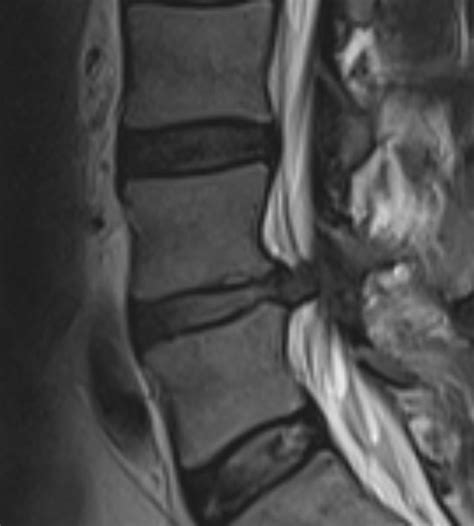 mri report lefthandedlayup