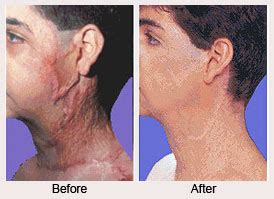 Reconstructive Burn Surgery Specialist Upper East Side New York Ny