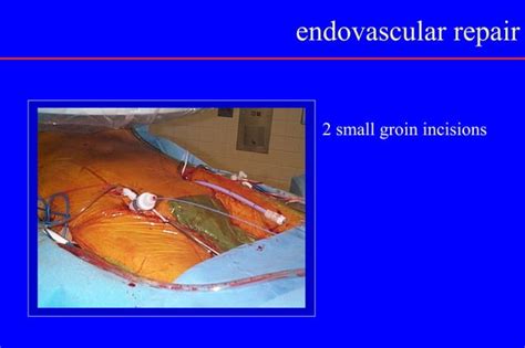 Abdominal Aortic Aneurysm Ppt