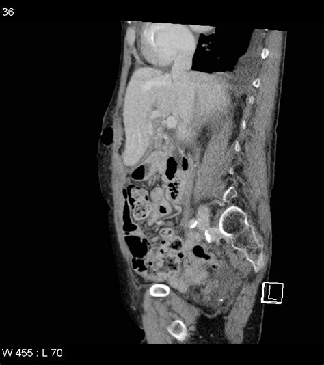 Duodenal Diverticulum Encasing The Common Bile Duct Image