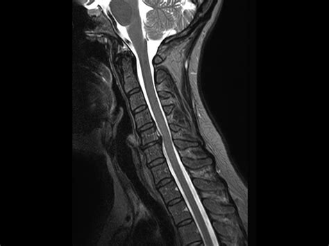 Cervical Spine Imaging With Robust Fatsat Philips Mr Body Map