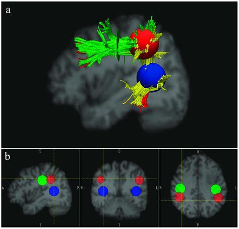 The Reconstruction Of The Bilateral Arcuate Fasciculus Af A A