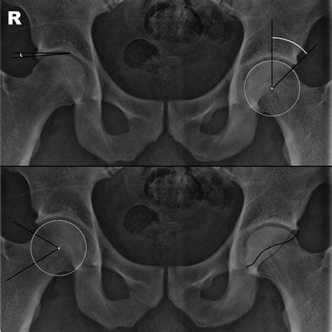 Fai Faq S Dr Rice Cam Impingement And Pincer Impingement Cincinnati