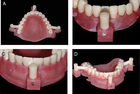 A Method To Improve Positioning Of Denture Teeth On Denture Bases For