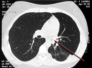 Asthma Imaging And Diagnosis Practice Essentials Radiography