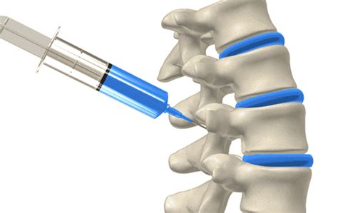 facet block spine surgery spine  clinic