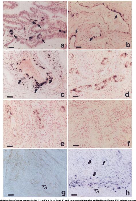 Figure From The Plasminogen Activation System In Human Colon Cancer