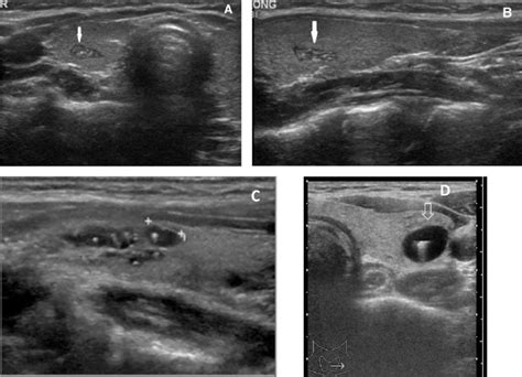 Colloid Nodule Thyroid Ultrasound