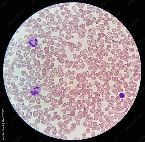 Foto De Human Blood Smear With Abnormal Red Blood Cells Morphology Call