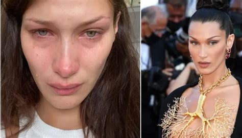 Slavna Manekenka Bella Hadid Objavila Fotografije Modrica I Zavoja Na