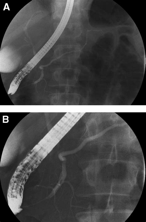 References In Endoscopic Retrograde Pancreatography Clinical