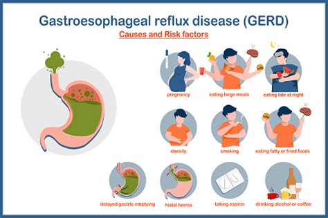 Causes And Risk Factors Of Gerd Stock Illustration Download Image Now Abdomen Acid Adult